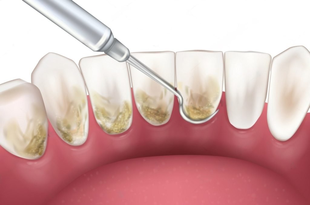 dental cleaning oshawa